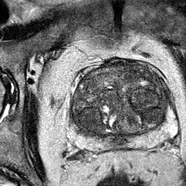 Normal gland anatomy, no lesion (Case 39) T2 axial source preview