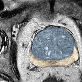 Normal gland anatomy, no lesion (Case 39) MRI preview