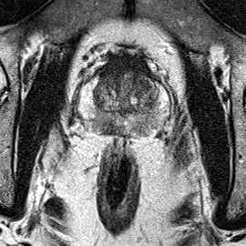 Peripheral-zone lesion, mid-gland (Case 40) T2 axial source preview