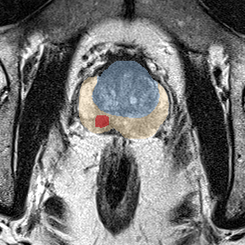 Peripheral-zone lesion, mid-gland (Case 40) MRI preview