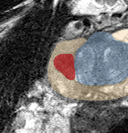 Peripheral-zone lesion, mid-gland (Case 41) lesion zoom preview