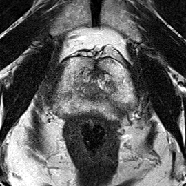 Peripheral-zone lesion, apex (Case 42) T2 axial source preview