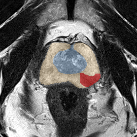 Peripheral-zone lesion, apex (Case 42) MRI preview