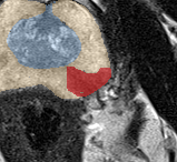 Peripheral-zone lesion, apex (Case 42) lesion zoom preview