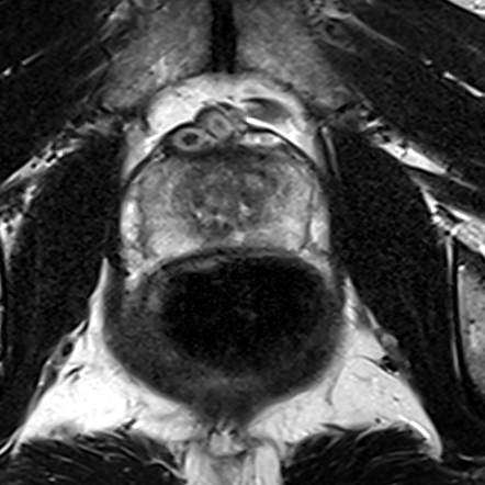 Normal gland anatomy, no lesion (Case 43) T2 axial source preview