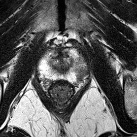 Peripheral-zone lesion, apex (Case 45) T2 axial source preview