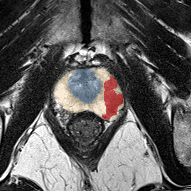 Peripheral-zone lesion, apex (Case 45) MRI preview