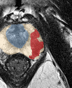Peripheral-zone lesion, apex (Case 45) lesion zoom preview