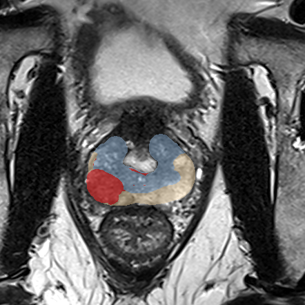 Peripheral-zone lesion, mid-gland (Case 47) MRI preview