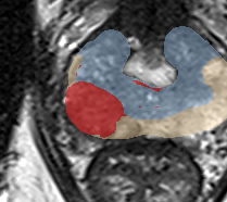 Peripheral-zone lesion, mid-gland (Case 47) lesion zoom preview