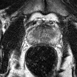 Peripheral-zone lesion, mid-gland (Case 48) T2 axial source preview