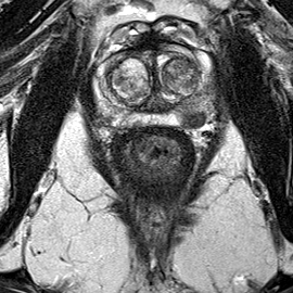 Peripheral-zone lesion, mid-gland (Case 49) T2 axial source preview