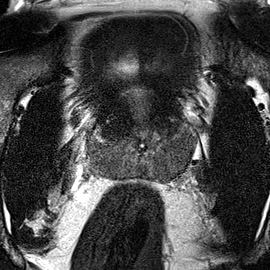 Normal gland anatomy, no lesion (Case 50) T2 axial source preview