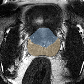 Normal gland anatomy, no lesion (Case 50) MRI preview