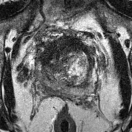 Transition-zone lesion, base (Case 51) T2 axial source preview