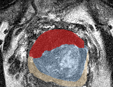 Transition-zone lesion, base (Case 51) lesion zoom preview