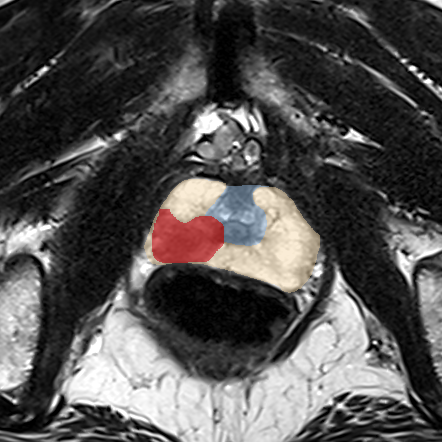Peripheral-zone lesion, apex (Case 52) MRI preview