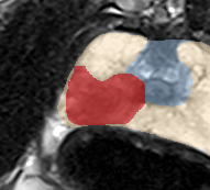 Peripheral-zone lesion, apex (Case 52) lesion zoom preview