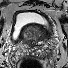 Transition-zone lesion, base (Case 54) T2 axial source preview
