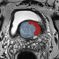 Transition-zone lesion, base (Case 54) MRI preview
