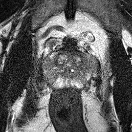 Peripheral-zone lesion, mid-gland (Case 55) T2 axial source preview