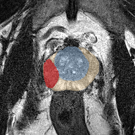 Peripheral-zone lesion, mid-gland (Case 55) MRI preview