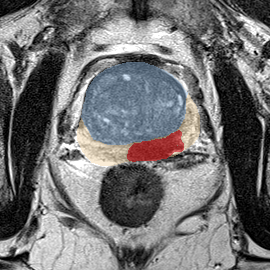 Peripheral-zone lesion, mid-gland (Case 56) MRI preview