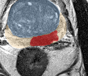 Peripheral-zone lesion, mid-gland (Case 56) lesion zoom preview