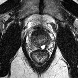 Normal gland anatomy, no lesion (Case 57) T2 axial source preview
