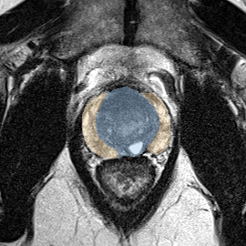 Normal gland anatomy, no lesion (Case 57) MRI preview