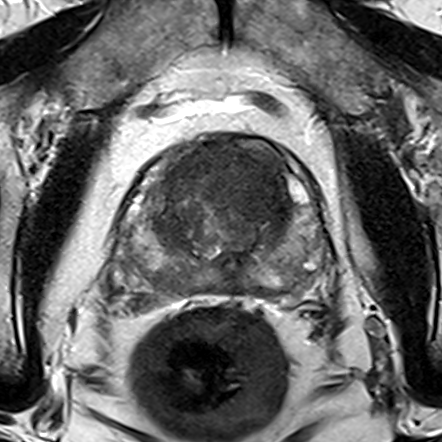 Transition-zone lesion, mid-gland (Case 58) T2 axial source preview