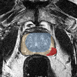 Peripheral-zone lesion, apex (Case 59) MRI preview