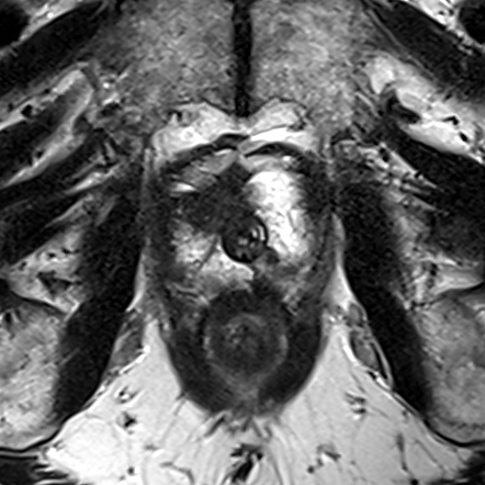 Peripheral-zone lesion, apex (Case 61) T2 axial source preview