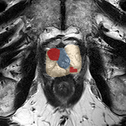 Peripheral-zone lesion, apex (Case 61) MRI preview