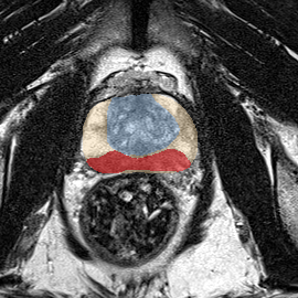 Peripheral-zone lesion, mid-gland (Case 62) MRI preview