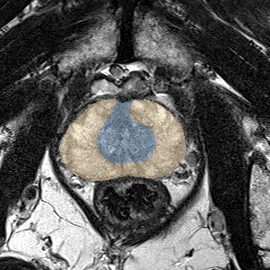 Normal gland anatomy, no lesion (Case 63) MRI preview