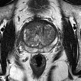 Transition-zone lesion, mid-gland (Case 64) T2 axial source preview