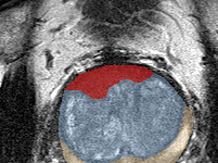 Transition-zone lesion, mid-gland (Case 64) lesion zoom preview