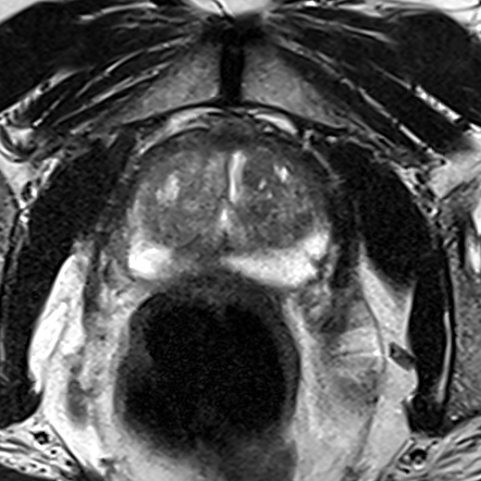 Peripheral-zone lesion, apex (Case 65) T2 axial source preview