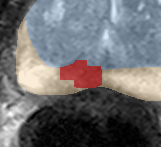 Peripheral-zone lesion, apex (Case 65) lesion zoom preview