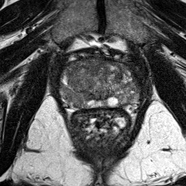 Transition-zone lesion, apex (Case 67) T2 axial source preview
