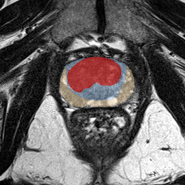 Transition-zone lesion, apex (Case 67) MRI preview