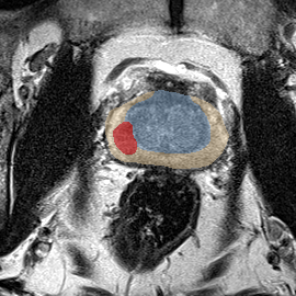 Peripheral-zone lesion, mid-gland (Case 68) MRI preview