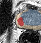 Peripheral-zone lesion, mid-gland (Case 68) lesion zoom preview