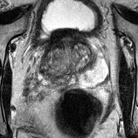 Normal gland anatomy, no lesion (Case 69) T2 axial source preview