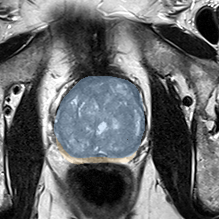 Normal gland anatomy, no lesion (Case 71) MRI preview