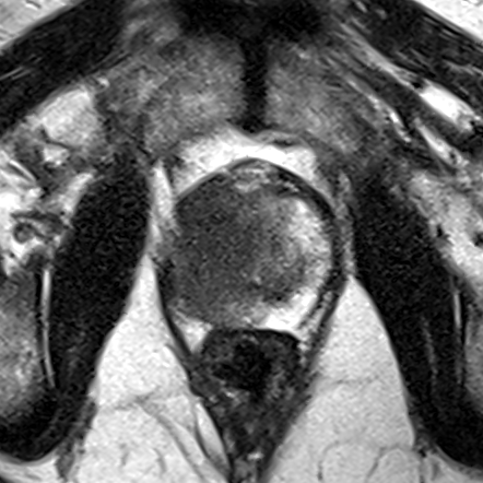 Transition-zone lesion, mid-gland (Case 72) T2 axial source preview