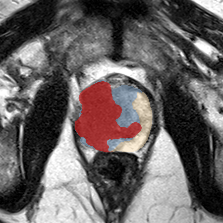 Transition-zone lesion, mid-gland (Case 72) MRI preview