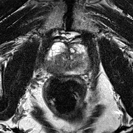Peripheral-zone lesion, mid-gland (Case 73) T2 axial source preview