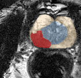 Peripheral-zone lesion, mid-gland (Case 73) lesion zoom preview